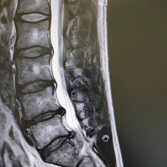 椎間板ヘルニア