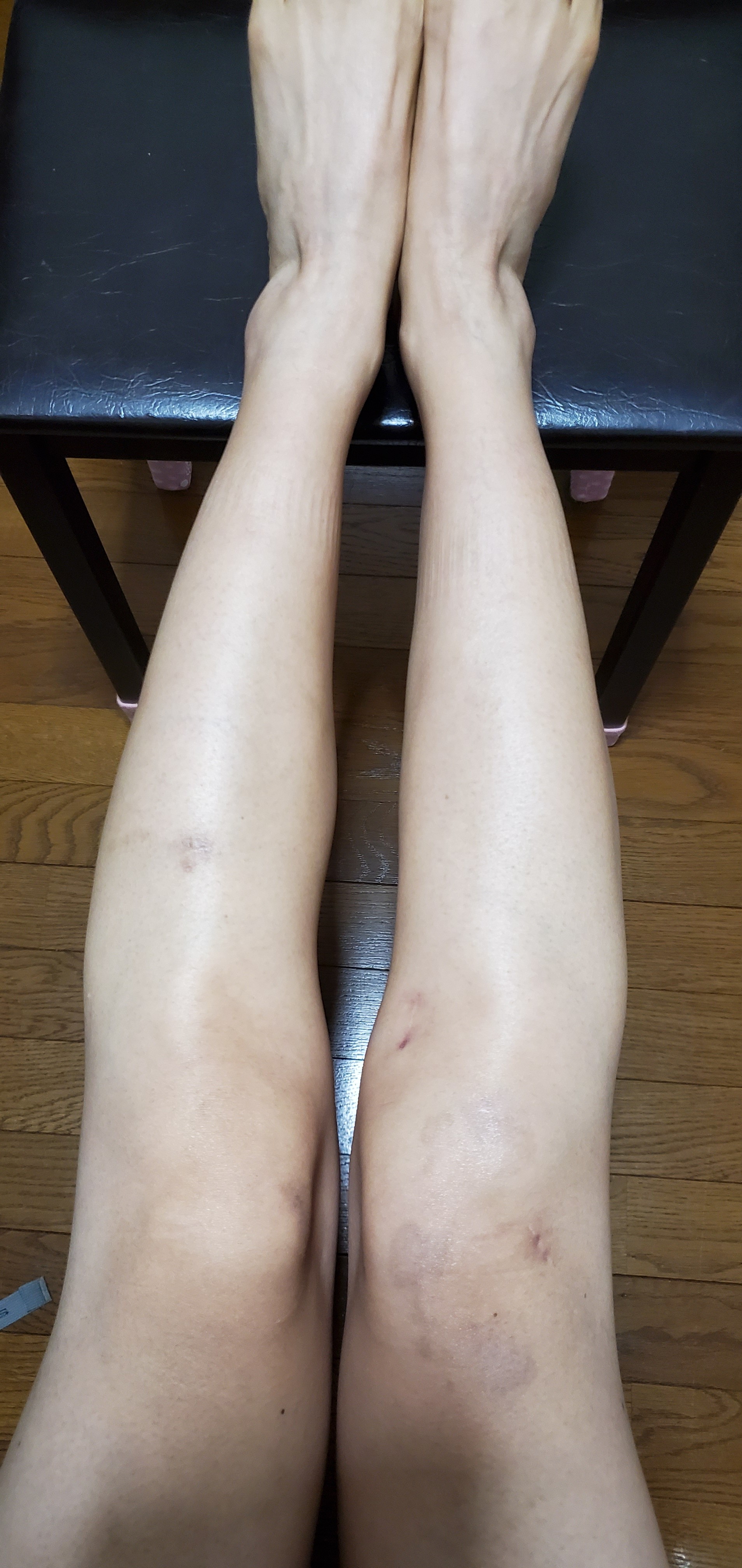 前十字靭帯再建 半月板除去術後1年の状態 Damens 活動休止中すんません すんません さんの大津市の活動日記 Yamap ヤマップ