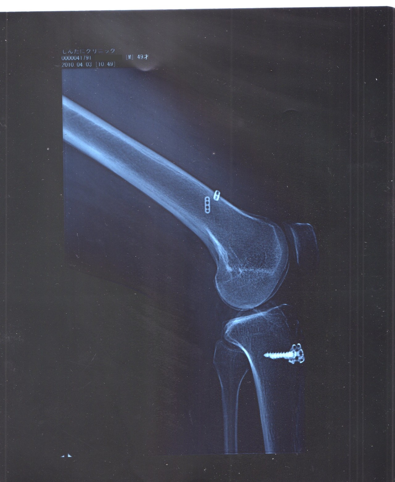 膝の故障履歴 山レポではありません ちょびちょびさんの金剛山 二上山 大和葛城山の活動日記 Yamap ヤマップ