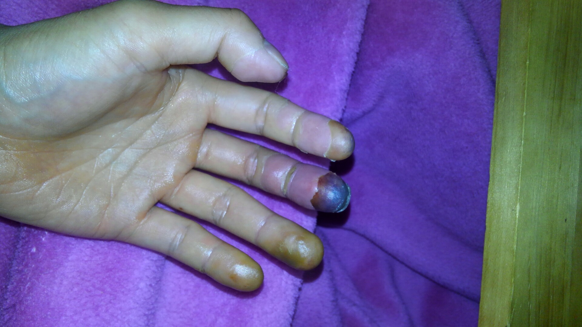 凍傷になりました 気ままに登山さんの常念岳 大天井岳 燕岳の活動日記 Yamap ヤマップ