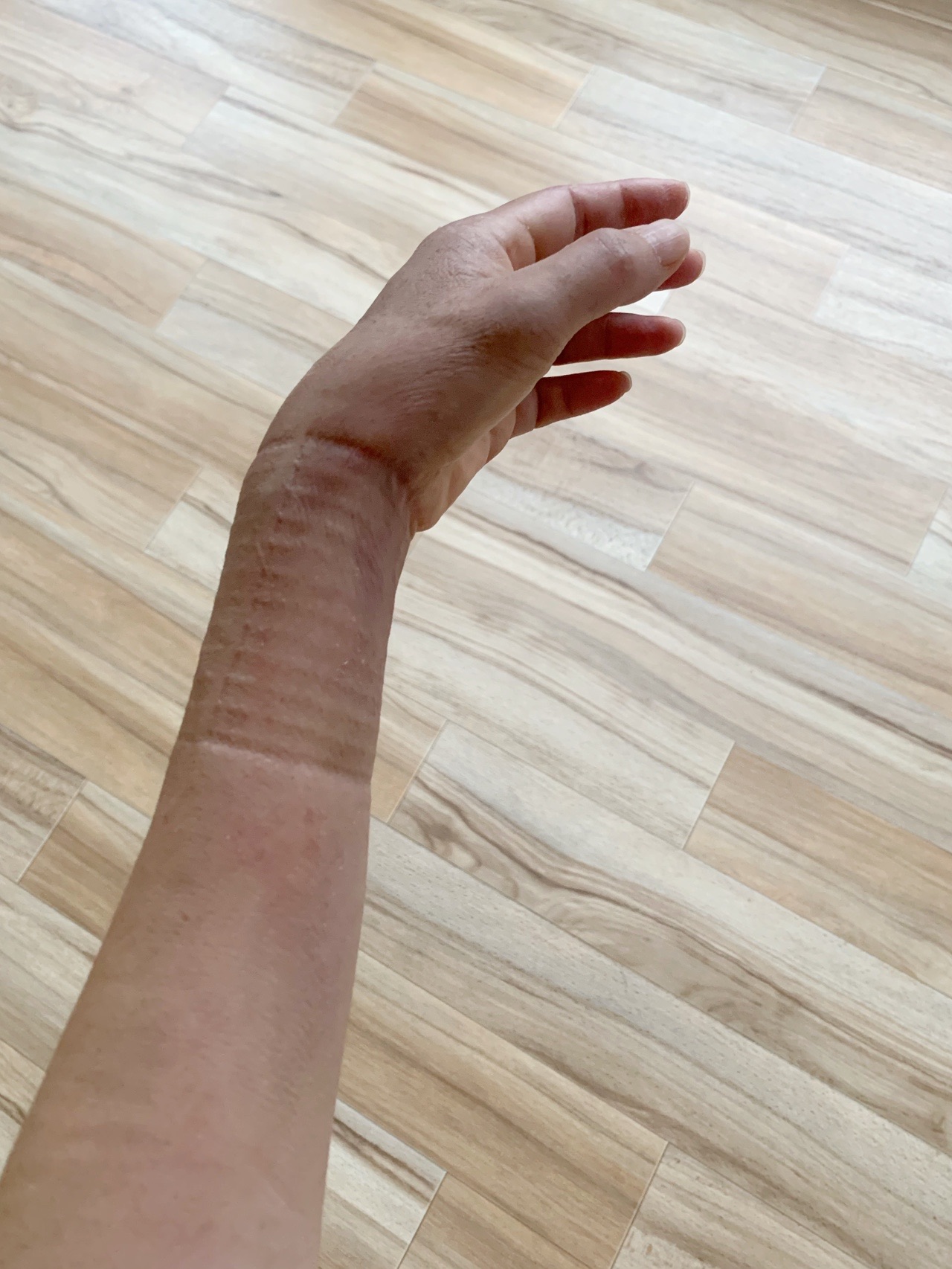 脱ギプスしました 骨折その後 07 11 いぬ登山部さんの久留米市の活動データ Yamap ヤマップ