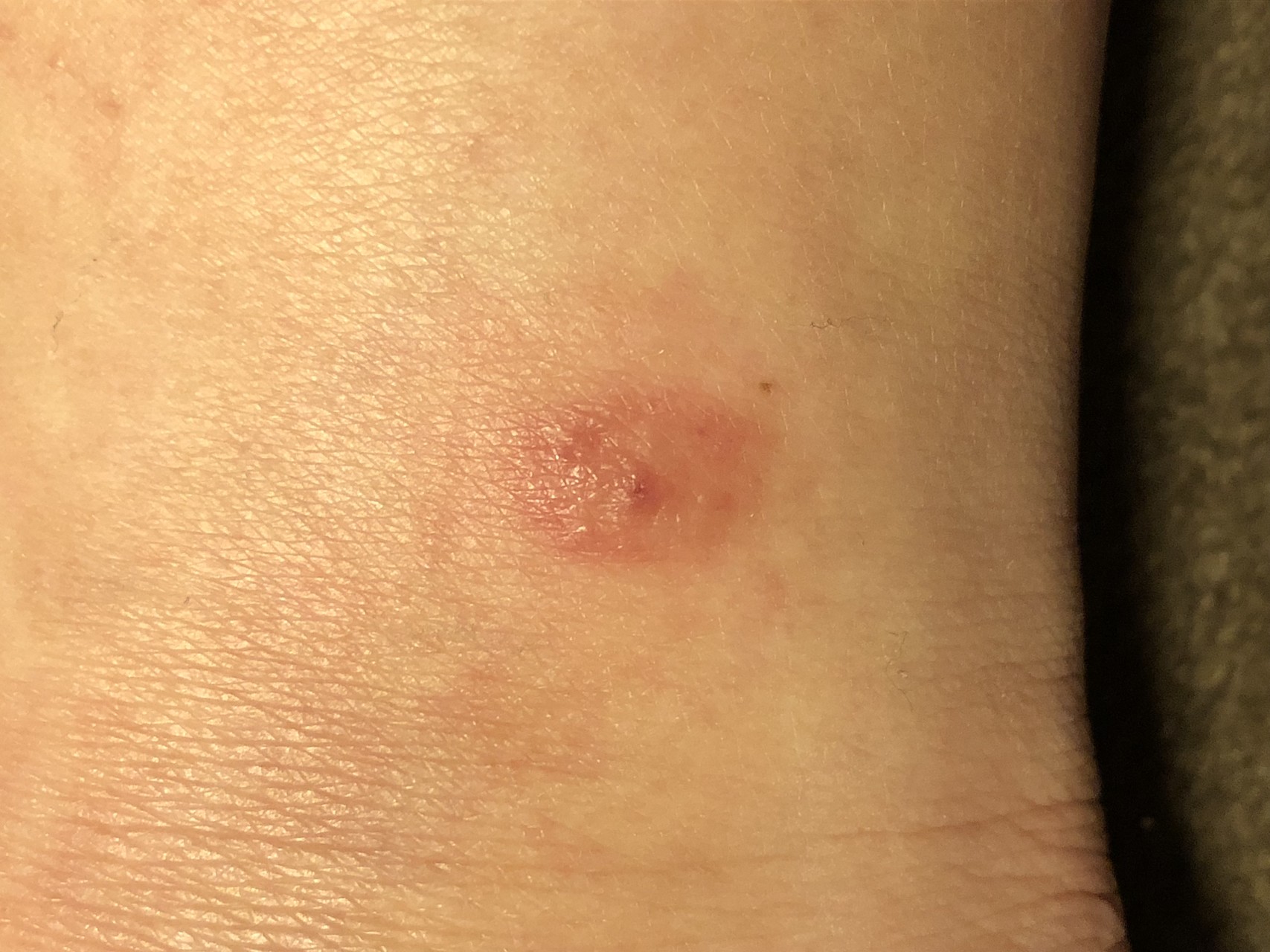 番外編 ジョニーにやられました と その後 ラムもふ さんの大山の活動日記 Yamap ヤマップ