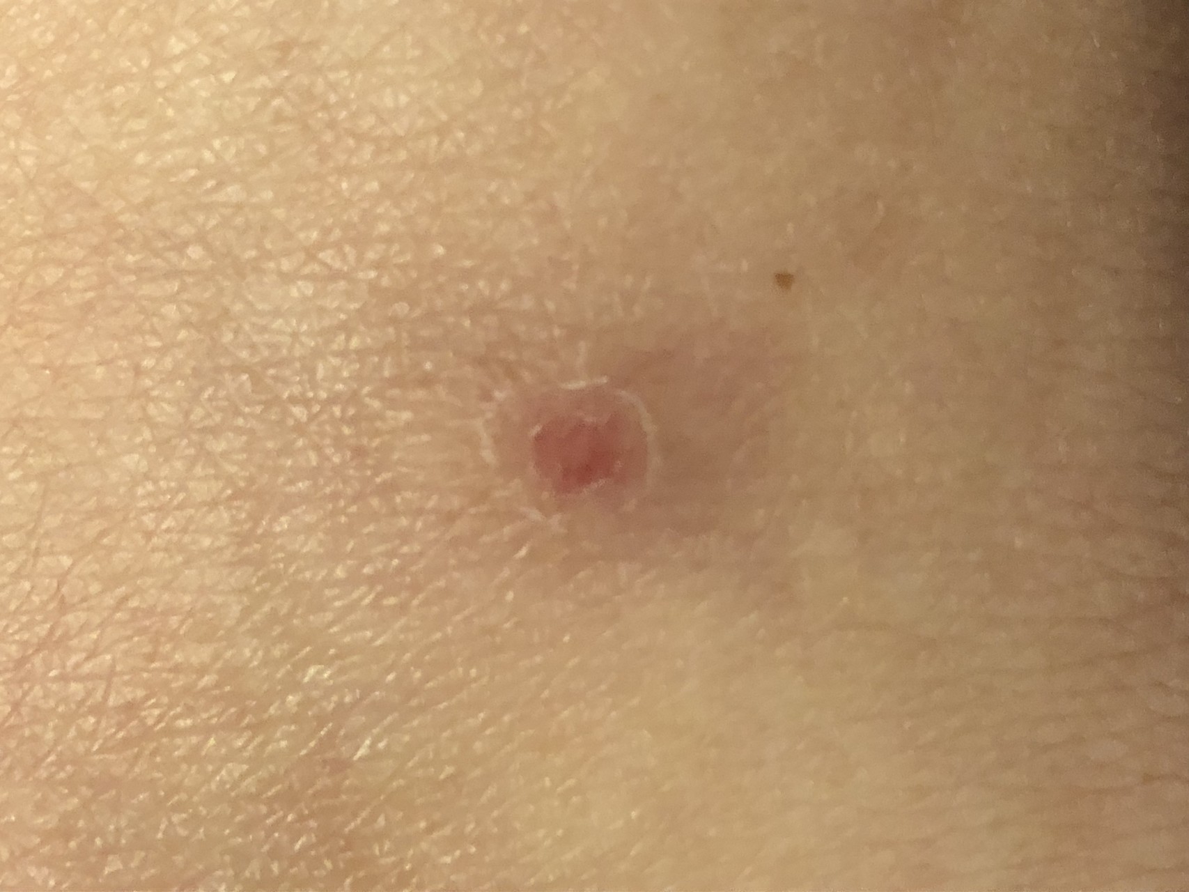 番外編 ジョニーにやられました と その後 ラムもふ さんの大山の活動日記 Yamap ヤマップ