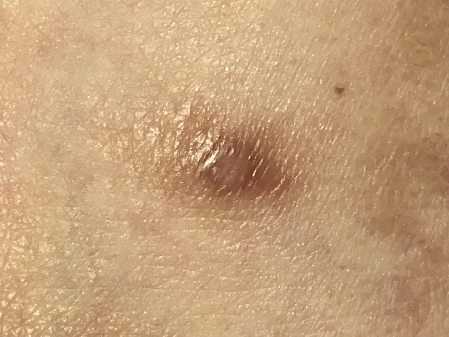 番外編 ジョニーにやられました と その後 ラムもふ さんの大山の活動日記 Yamap ヤマップ