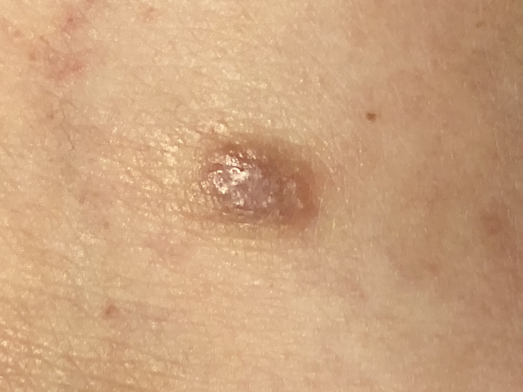 番外編 ジョニーにやられました と その後 ラムもふ さんの大山の活動日記 Yamap ヤマップ