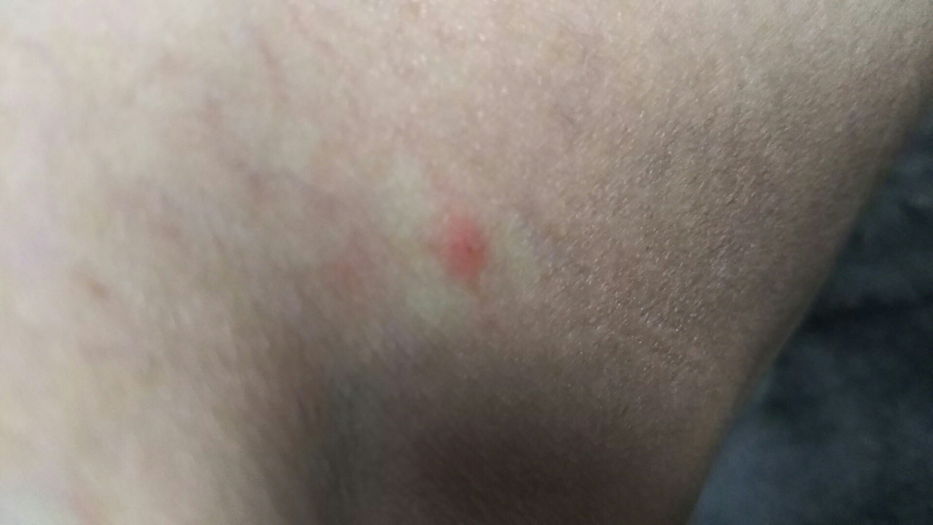 マダニ 噛ま れ た 跡 マダニに刺された跡の画像と体験談 病院は何科 取り方は