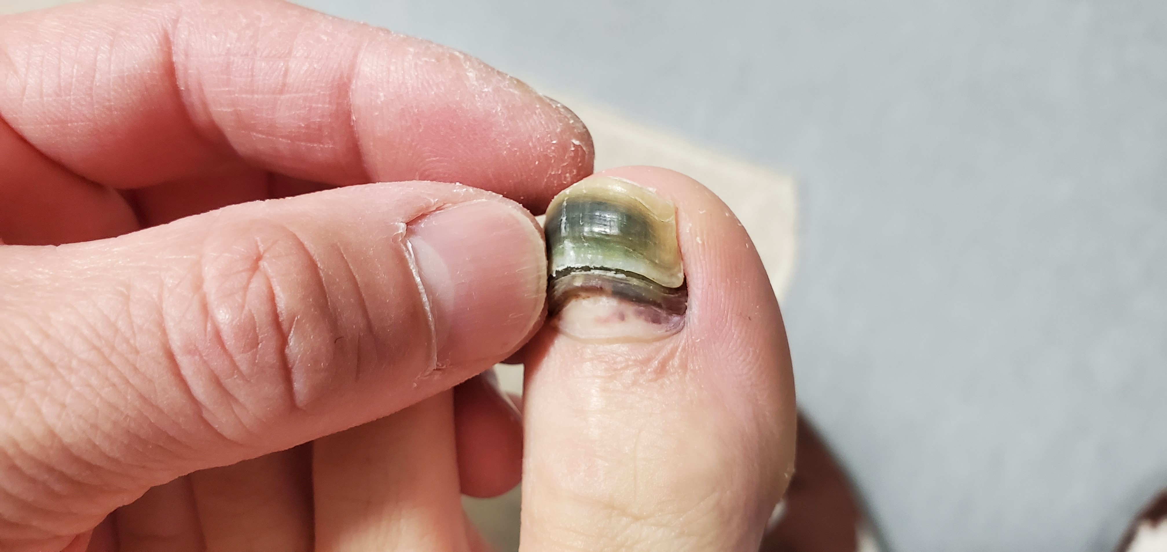 爪が取れました 汚い画像失礼します ゲシゲシさんのモーメント Yamap ヤマップ