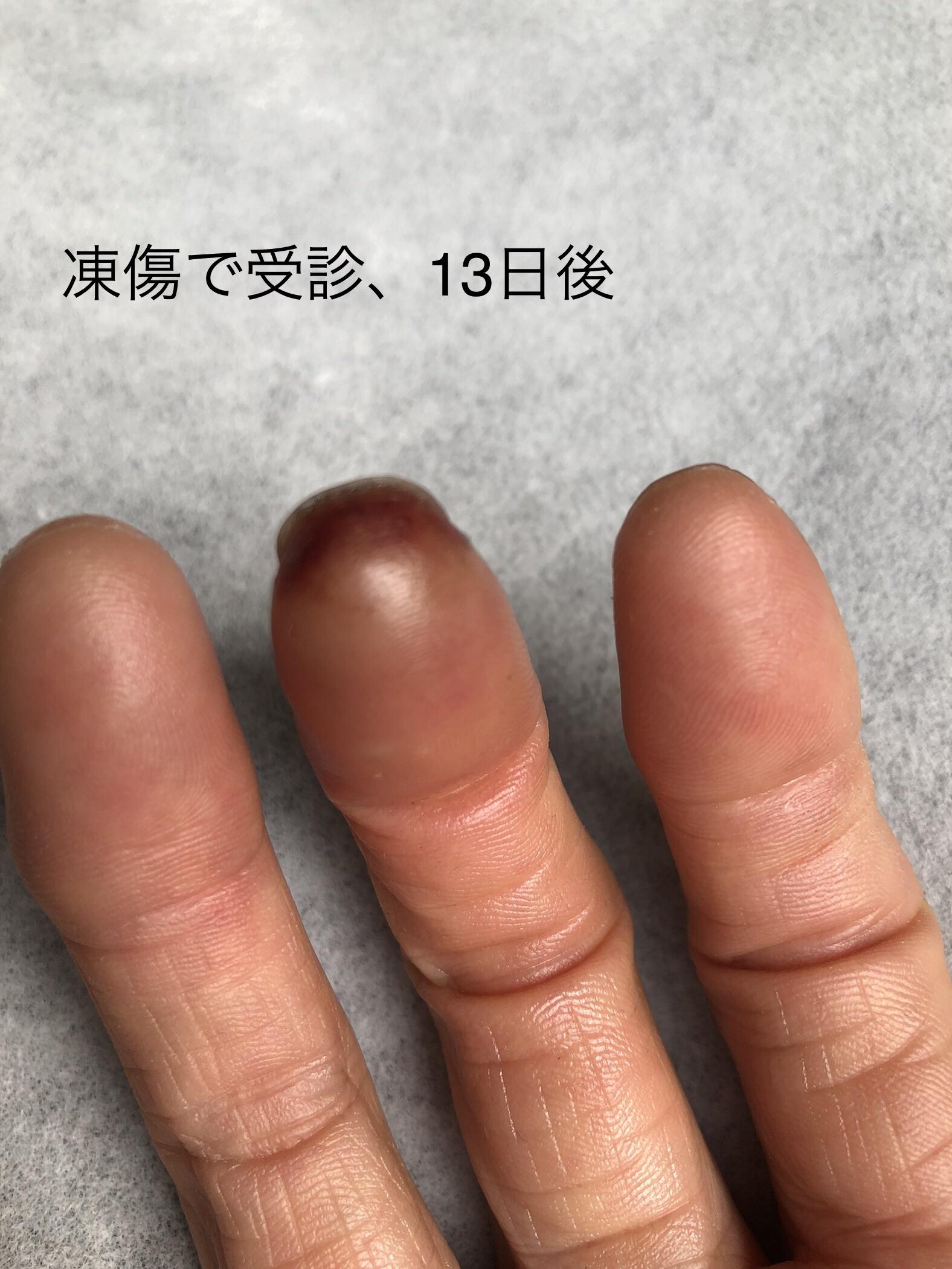 【凍傷33日後】 2/11凍傷になりまし... / ぐっちさんのモーメント | YAMAP / ヤマップ