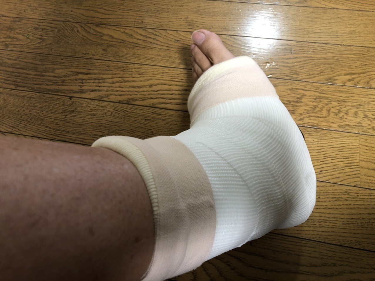 ギブスをしてみました 今のギブス固定っ き さんのモーメント Yamap ヤマップ