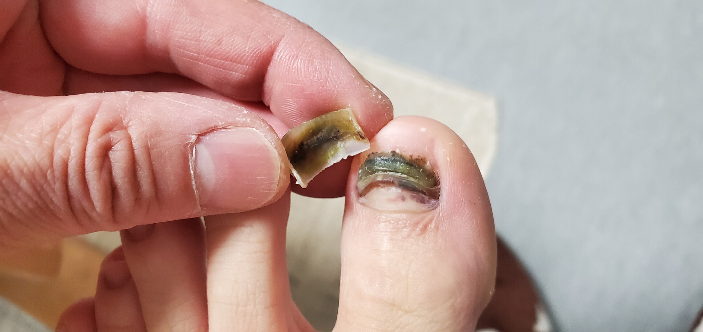 爪が取れました 汚い画像失礼します ゲシゲシさんのモーメント Yamap ヤマップ