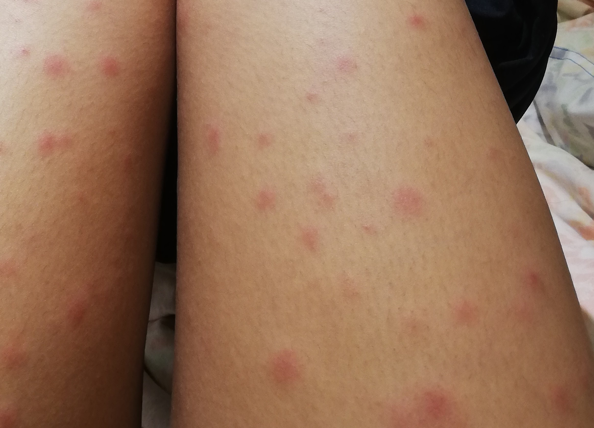 マダニ感染症レポ 横山 迫子浅間山 みほっちさんの志摩市の活動日記 Yamap ヤマップ