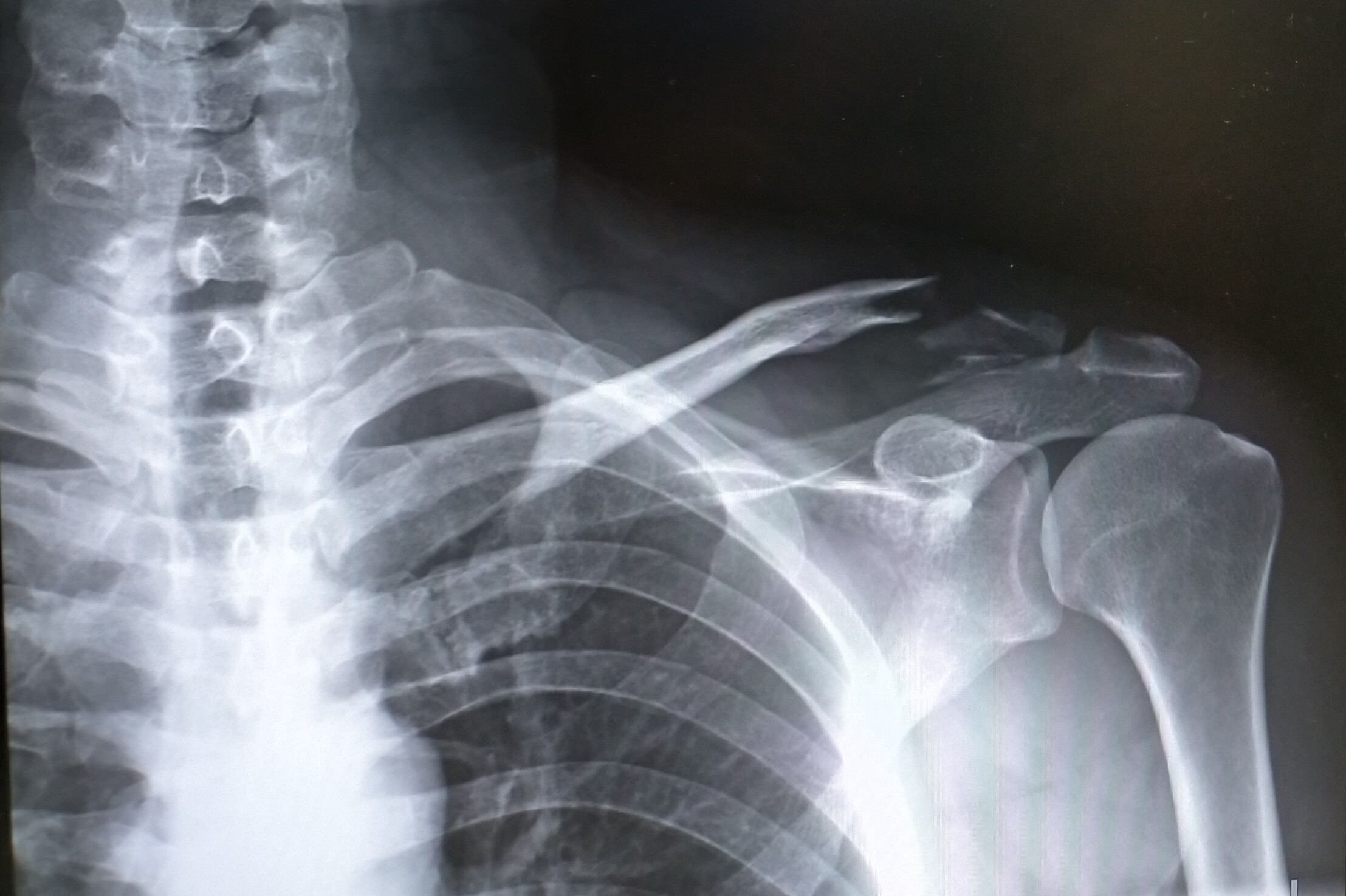 お久しぶりです チャリで落車して左鎖骨と肋骨6本骨折して手術しました かがみくさんの鳥取市の活動データ Yamap ヤマップ