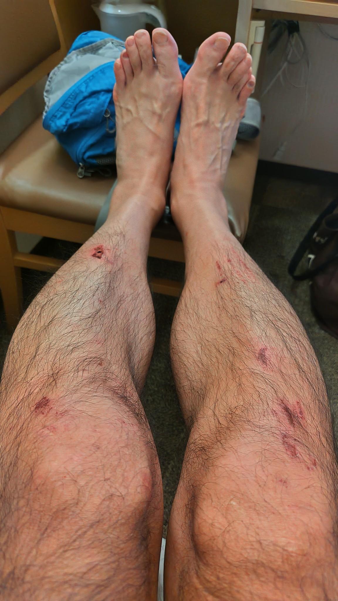 帰還後の脚。
履いてたCWXは穴だらけ、脚は傷だらけ!!
