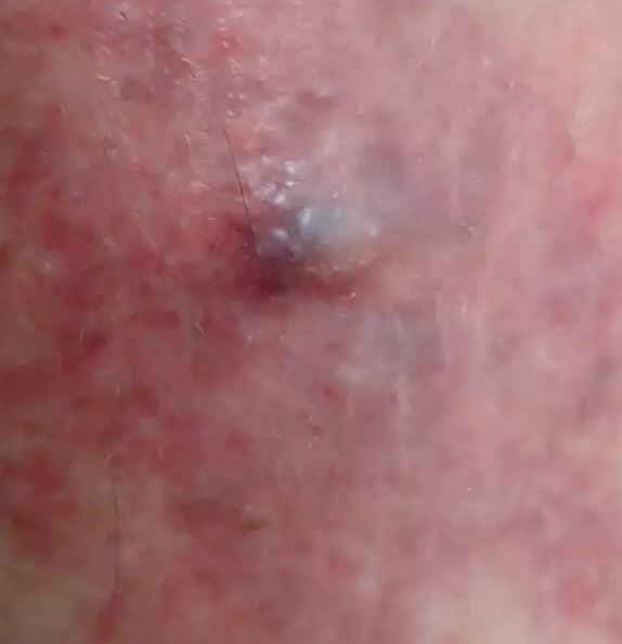 登山での虫刺され侮るなかれ ブヨ ブ キタカゼさんのモーメント Yamap ヤマップ