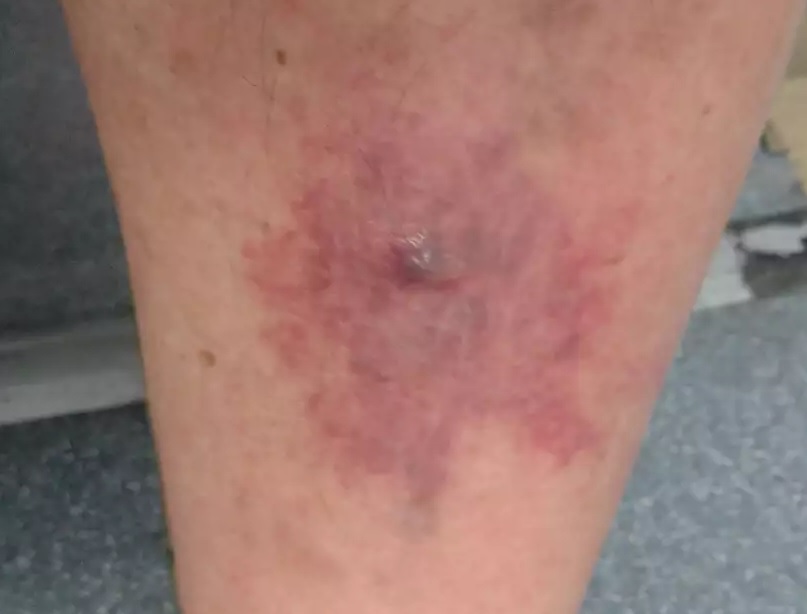 登山での虫刺され侮るなかれ ブヨ ブ キタカゼさんのモーメント Yamap ヤマップ